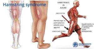 hamstring syndrome riabilitazione campania