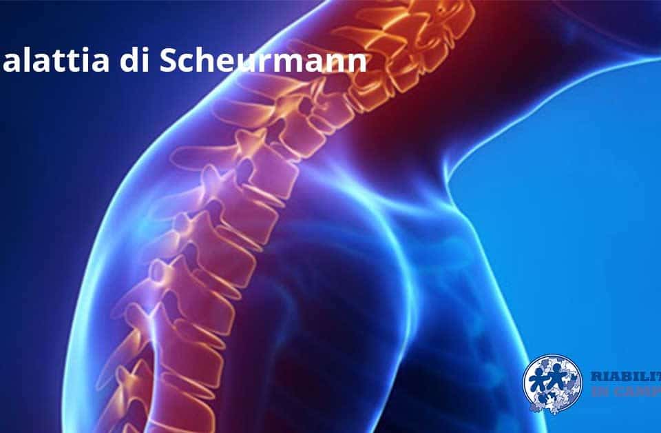 malattia di Scheuermann riabilitazione campania napoli