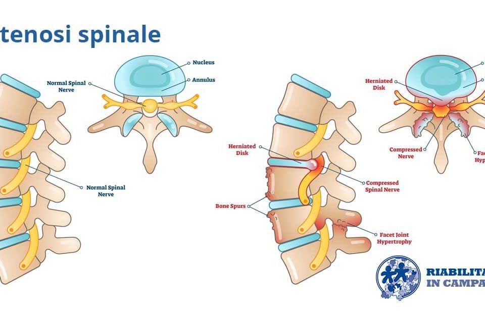 immagine rappresentativa lastenosi spinale riabilitazione campania