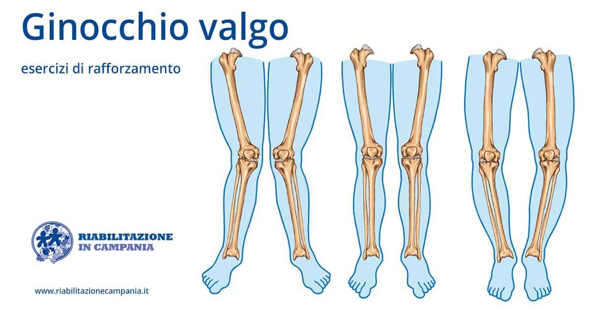 l immagine presenta un ipotesi di ginocchio valgo fisioterapia e riabilitazione napoli