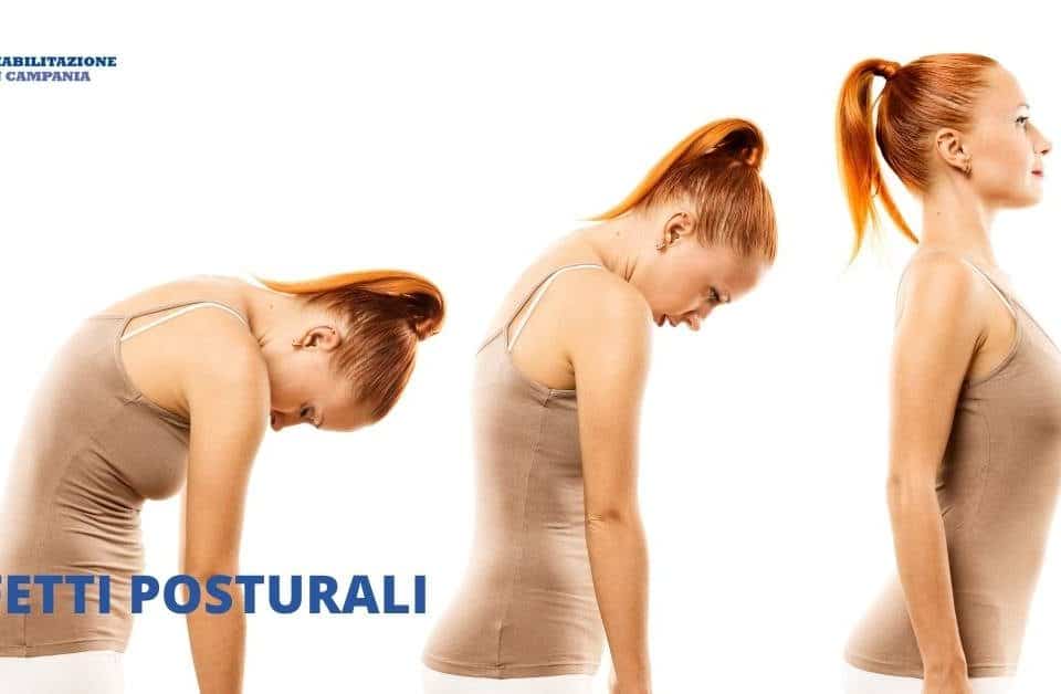Difetti posturali - Riabilitazione campania