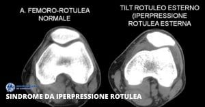 Iperpressione rotulea fisioterapia per sindrome napoli