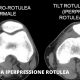 fisioterapia per sindrome Iperpressione rotulea napoli